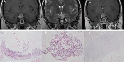 Suprasellar Mature Cystic Teratoma Mimicking Rathke’s Cleft Cyst: A Case Report and Systematic Review of the Literature